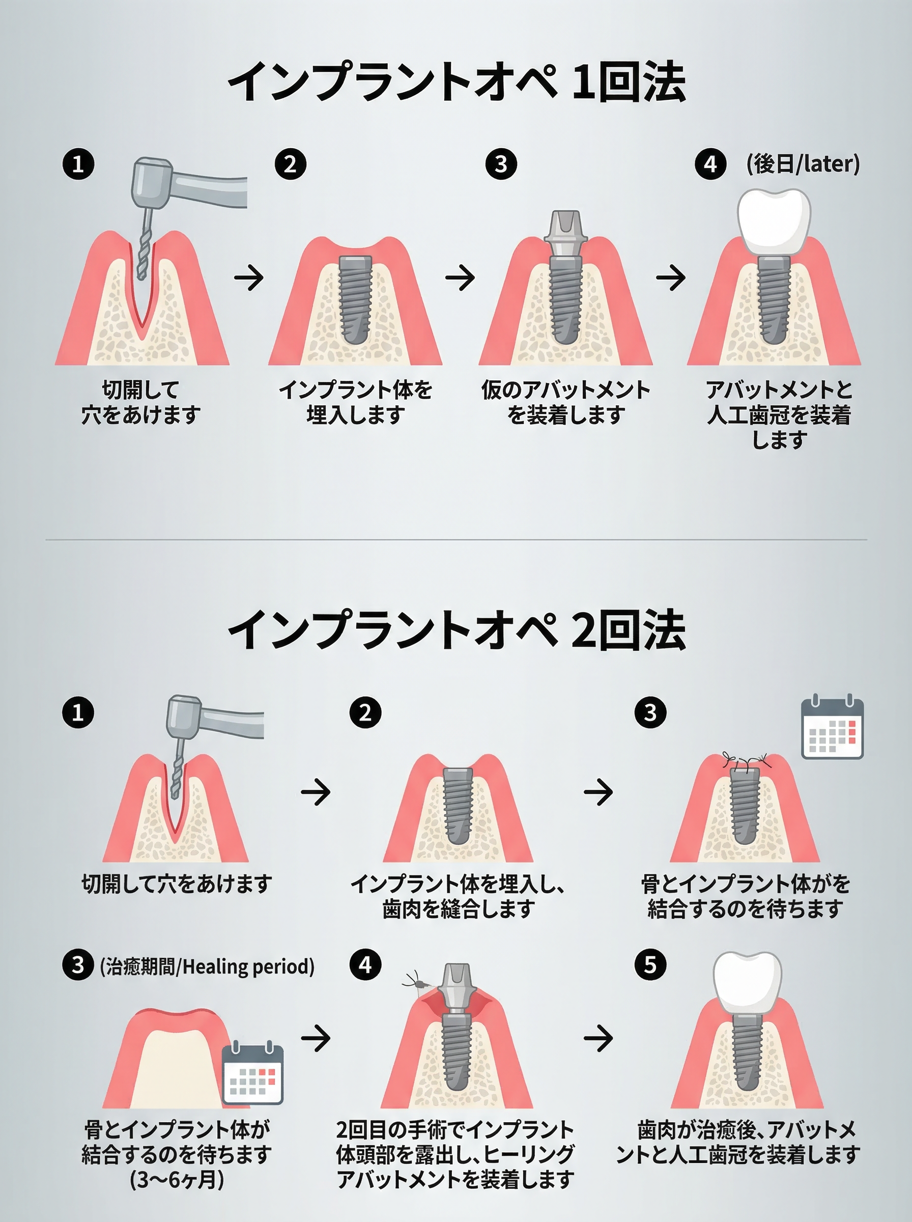 インプラント1回法と2回法