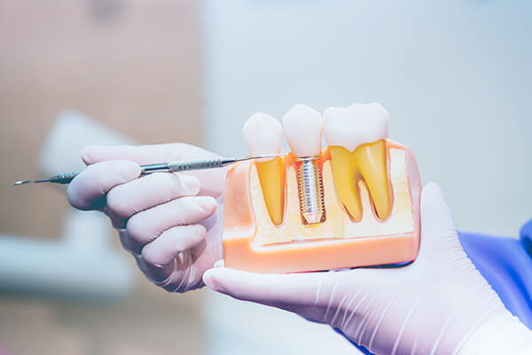 インプラントに対応